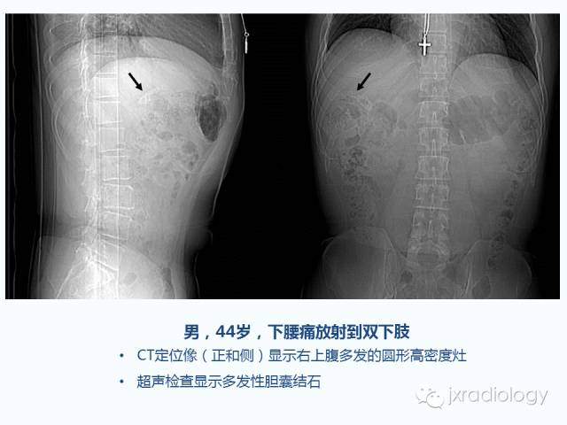 【PPT】腰椎CT、MRI检查的脊柱外异常发现：图文综述