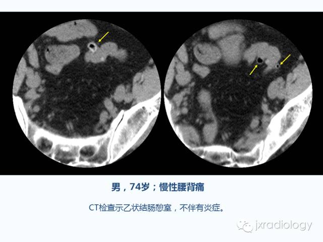 【PPT】腰椎CT、MRI检查的脊柱外异常发现：图文综述