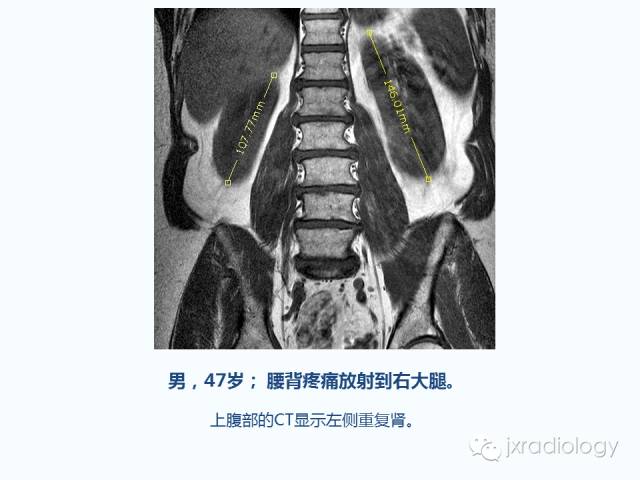 【PPT】腰椎CT、MRI检查的脊柱外异常发现：图文综述