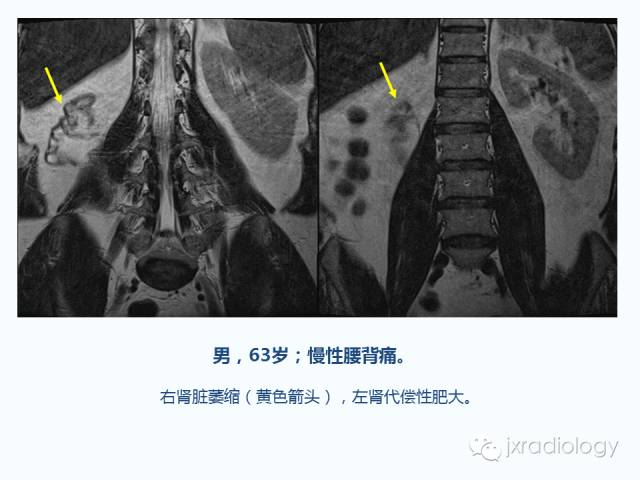 【PPT】腰椎CT、MRI检查的脊柱外异常发现：图文综述