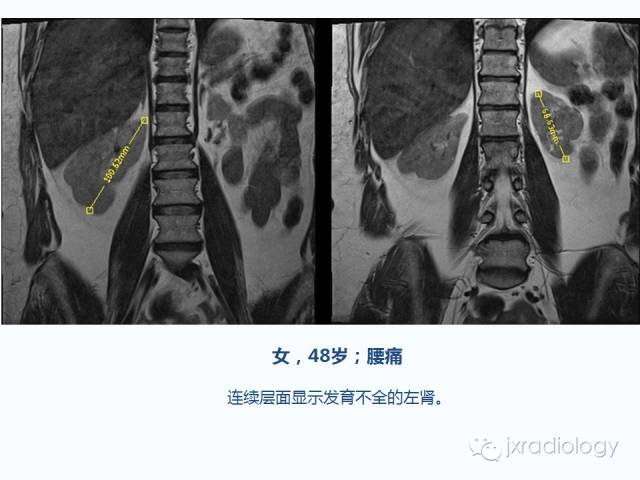 【PPT】腰椎CT、MRI检查的脊柱外异常发现：图文综述
