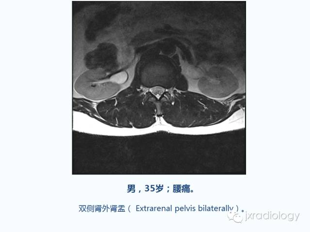 【PPT】腰椎CT、MRI检查的脊柱外异常发现：图文综述