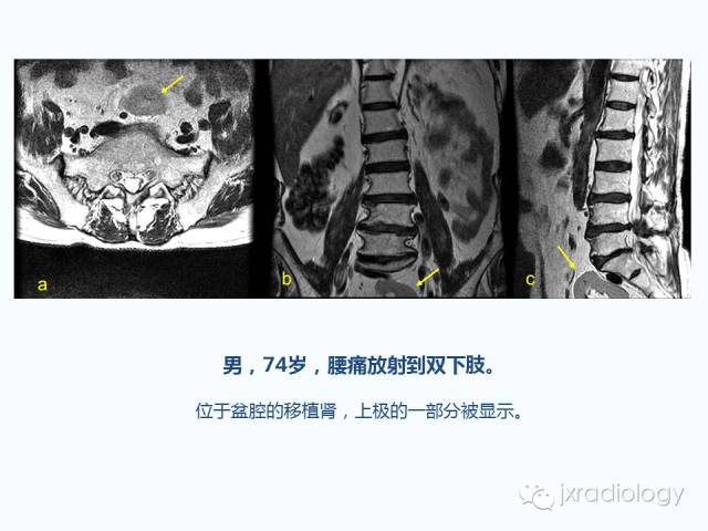 【PPT】腰椎CT、MRI检查的脊柱外异常发现：图文综述
