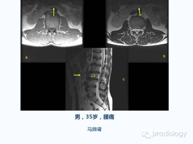 【PPT】腰椎CT、MRI检查的脊柱外异常发现：图文综述