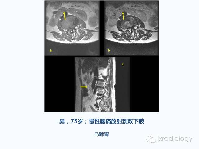 【PPT】腰椎CT、MRI检查的脊柱外异常发现：图文综述