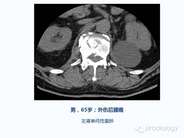 【PPT】腰椎CT、MRI检查的脊柱外异常发现：图文综述