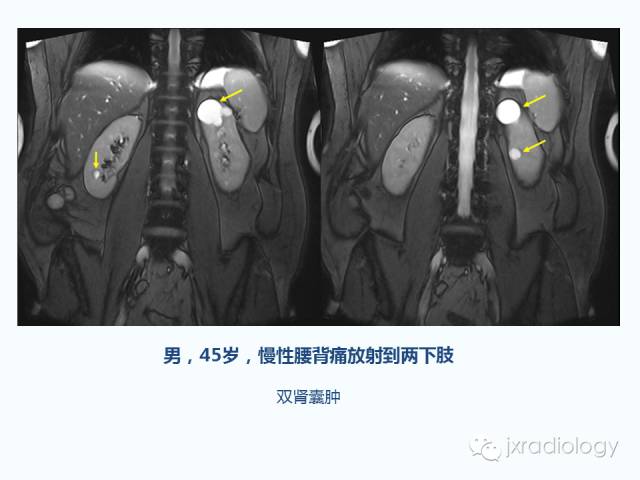 【PPT】腰椎CT、MRI检查的脊柱外异常发现：图文综述