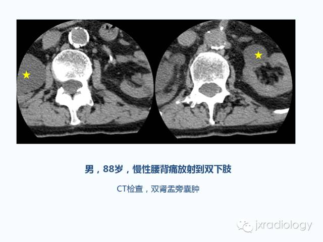 【PPT】腰椎CT、MRI检查的脊柱外异常发现：图文综述