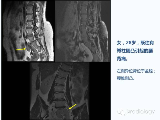 【PPT】腰椎CT、MRI检查的脊柱外异常发现：图文综述