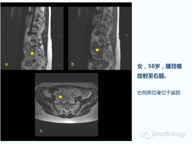 【PPT】腰椎CT、MRI检查的脊柱外异常发现：图文综述