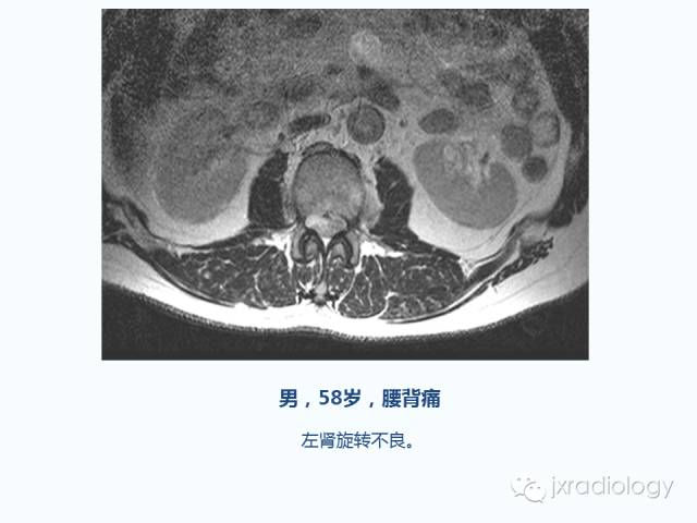 【PPT】腰椎CT、MRI检查的脊柱外异常发现：图文综述
