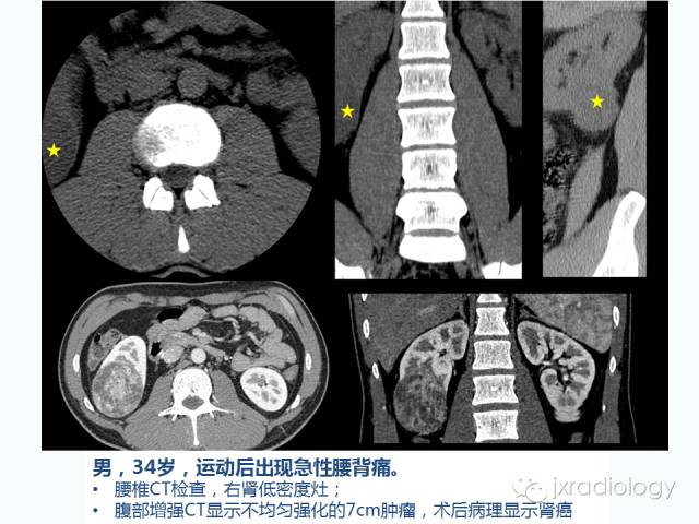 【PPT】腰椎CT、MRI检查的脊柱外异常发现：图文综述