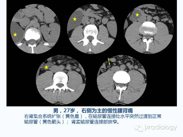 【PPT】腰椎CT、MRI检查的脊柱外异常发现：图文综述