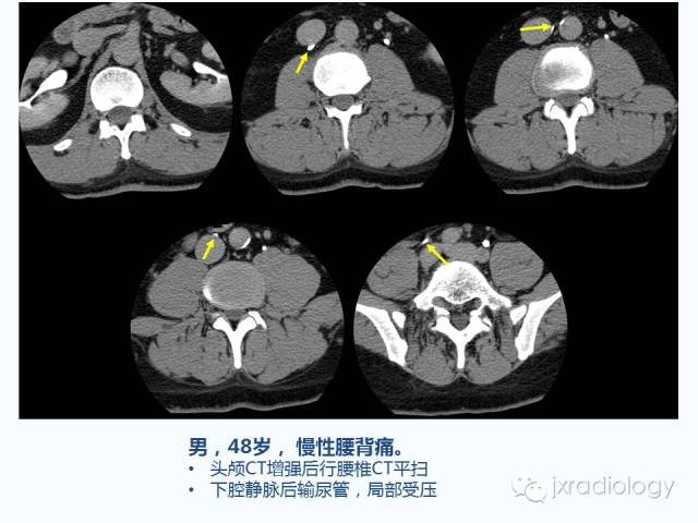 【PPT】腰椎CT、MRI检查的脊柱外异常发现：图文综述