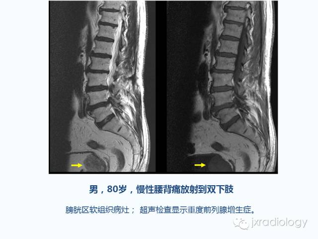 【PPT】腰椎CT、MRI检查的脊柱外异常发现：图文综述
