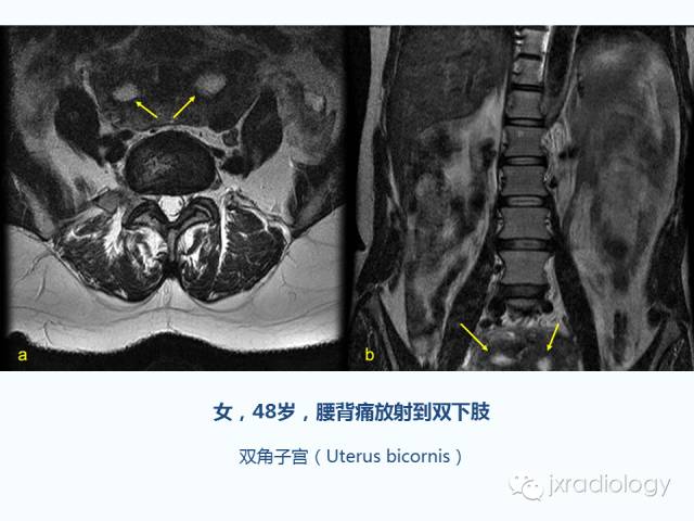 【PPT】腰椎CT、MRI检查的脊柱外异常发现：图文综述