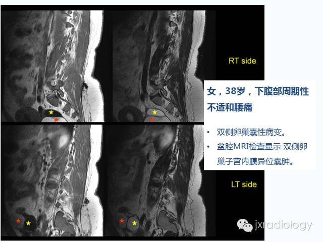【PPT】腰椎CT、MRI检查的脊柱外异常发现：图文综述