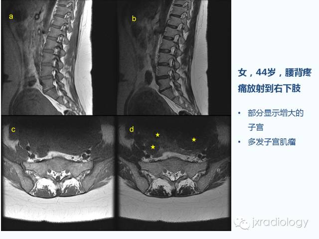 【PPT】腰椎CT、MRI检查的脊柱外异常发现：图文综述