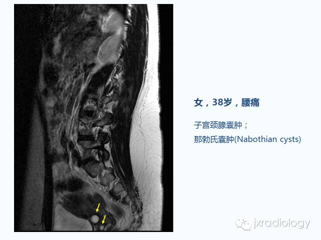【PPT】腰椎CT、MRI检查的脊柱外异常发现：图文综述
