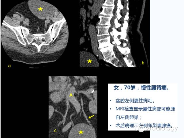 【PPT】腰椎CT、MRI检查的脊柱外异常发现：图文综述
