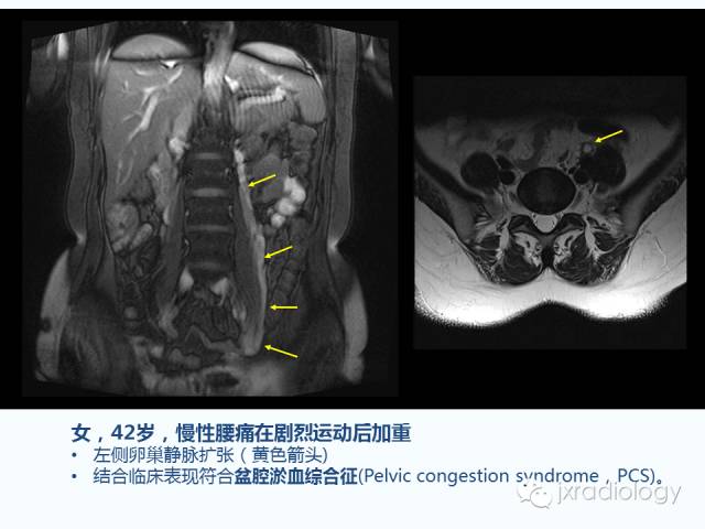【PPT】腰椎CT、MRI检查的脊柱外异常发现：图文综述