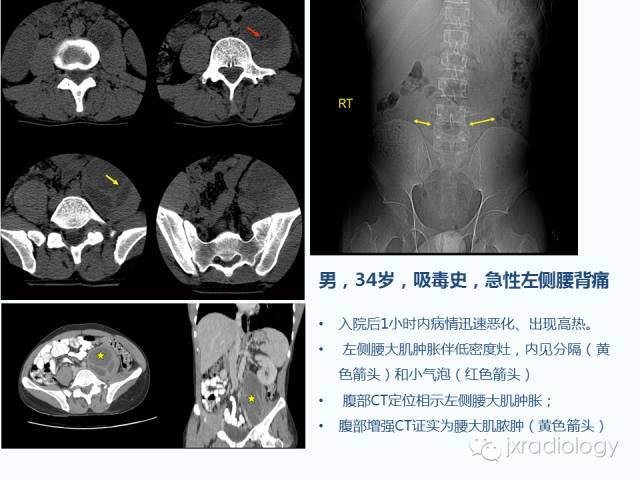 【PPT】腰椎CT、MRI检查的脊柱外异常发现：图文综述