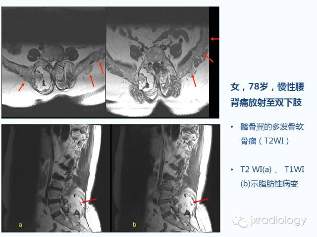【PPT】腰椎CT、MRI检查的脊柱外异常发现：图文综述