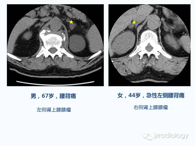 【PPT】腰椎CT、MRI检查的脊柱外异常发现：图文综述