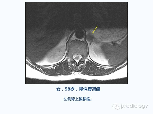 【PPT】腰椎CT、MRI检查的脊柱外异常发现：图文综述