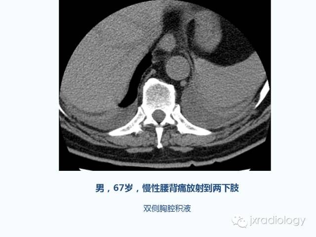 【PPT】腰椎CT、MRI检查的脊柱外异常发现：图文综述