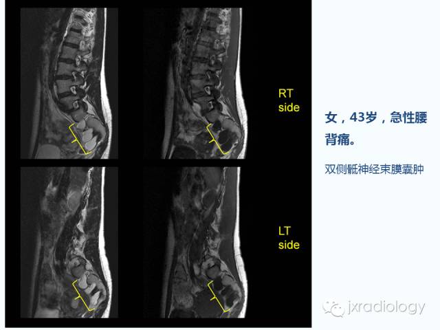 【PPT】腰椎CT、MRI检查的脊柱外异常发现：图文综述