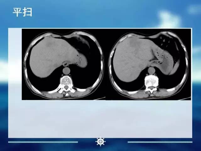 【病例】肝内胆管细胞癌1例CT影像表现 【病例】肝内胆管细胞癌1例CT影像表现