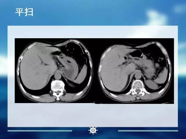 【病例】肝内胆管细胞癌1例CT影像表现 【病例】肝内胆管细胞癌1例CT影像表现