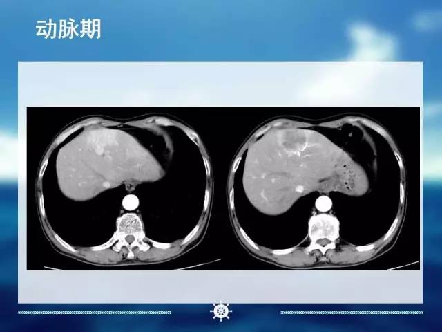 【病例】肝内胆管细胞癌1例CT影像表现 【病例】肝内胆管细胞癌1例CT影像表现