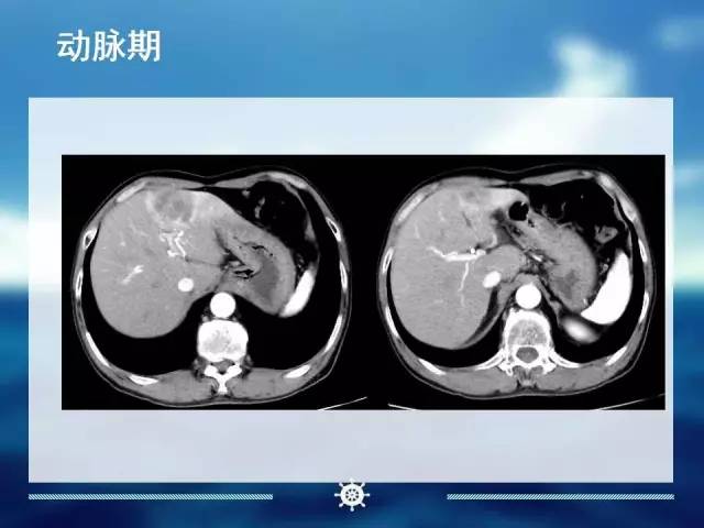 【病例】肝内胆管细胞癌1例CT影像表现 【病例】肝内胆管细胞癌1例CT影像表现