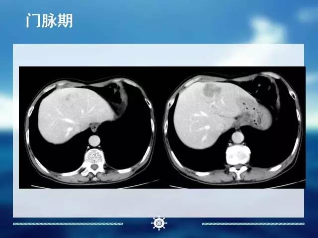 【病例】肝内胆管细胞癌1例CT影像表现 【病例】肝内胆管细胞癌1例CT影像表现