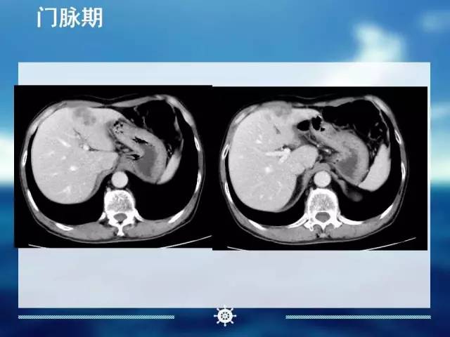 【病例】肝内胆管细胞癌1例CT影像表现 【病例】肝内胆管细胞癌1例CT影像表现
