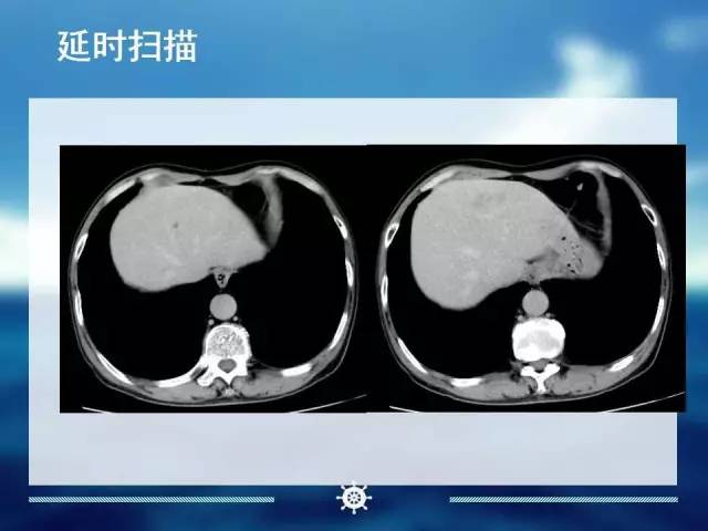 【病例】肝内胆管细胞癌1例CT影像表现 【病例】肝内胆管细胞癌1例CT影像表现