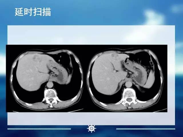【病例】肝内胆管细胞癌1例CT影像表现 【病例】肝内胆管细胞癌1例CT影像表现