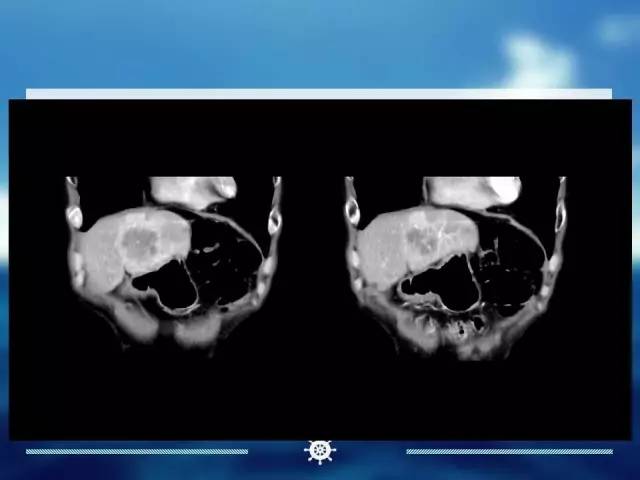 【病例】肝内胆管细胞癌1例CT影像表现 【病例】肝内胆管细胞癌1例CT影像表现