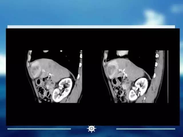 【病例】肝内胆管细胞癌1例CT影像表现 【病例】肝内胆管细胞癌1例CT影像表现