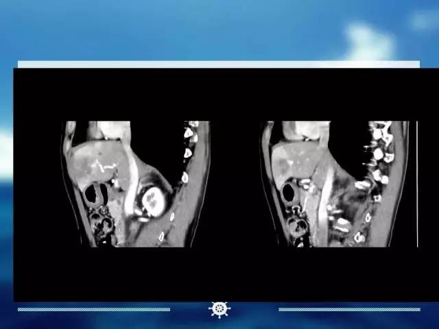【病例】肝内胆管细胞癌1例CT影像表现 【病例】肝内胆管细胞癌1例CT影像表现