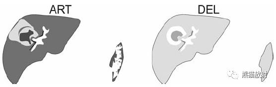 结直肠癌肝转移瘤:单发巨大瘤的表现;SRT/RFA治疗后改变 结直肠癌肝转移瘤:单发巨大瘤的表现;SRT/RFA治疗后改变