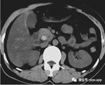 【病例】胆总管结石致肝内外胆管扩张及慢性炎症1例CT 【病例】胆总管结石致肝内外胆管扩张及慢性炎症1例CT