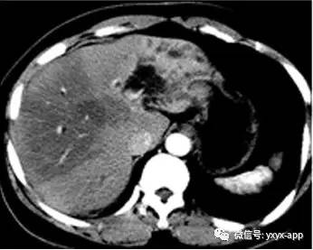 【病例】胆总管结石致肝内外胆管扩张及慢性炎症1例CT