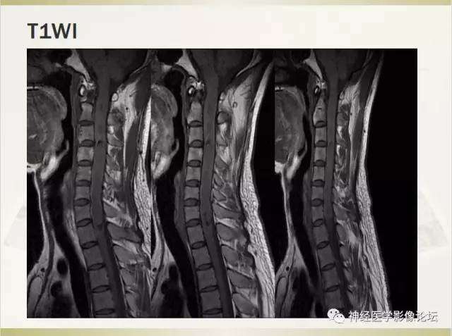 【病例】脊髓室管膜瘤1例MR影像表现 【病例】脊髓室管膜瘤1例MR影像表现