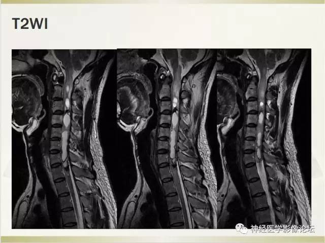 【病例】脊髓室管膜瘤1例MR影像表现