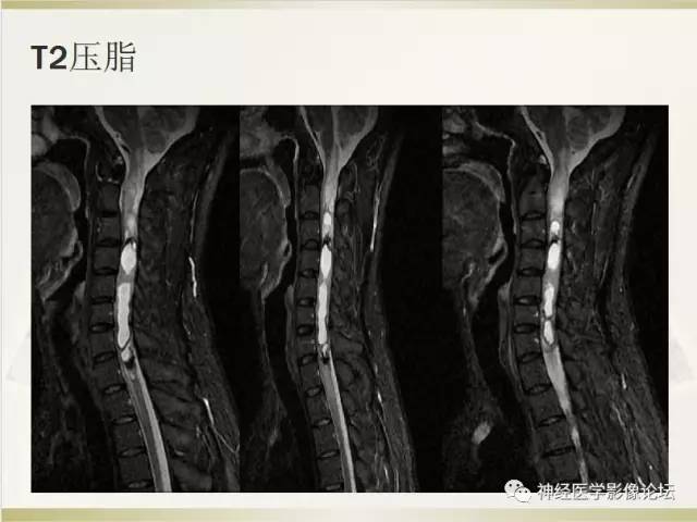 【病例】脊髓室管膜瘤1例MR影像表现 【病例】脊髓室管膜瘤1例MR影像表现