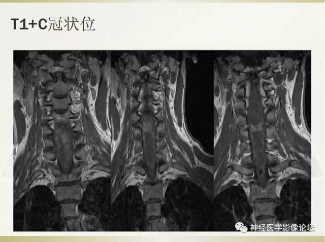 【病例】脊髓室管膜瘤1例MR影像表现 【病例】脊髓室管膜瘤1例MR影像表现