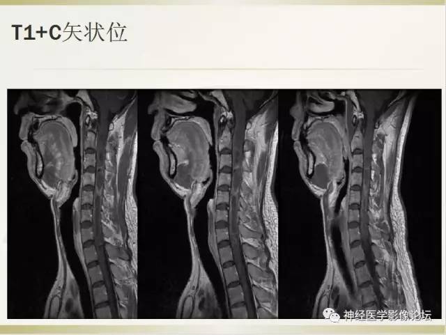 【病例】脊髓室管膜瘤1例MR影像表现 【病例】脊髓室管膜瘤1例MR影像表现
